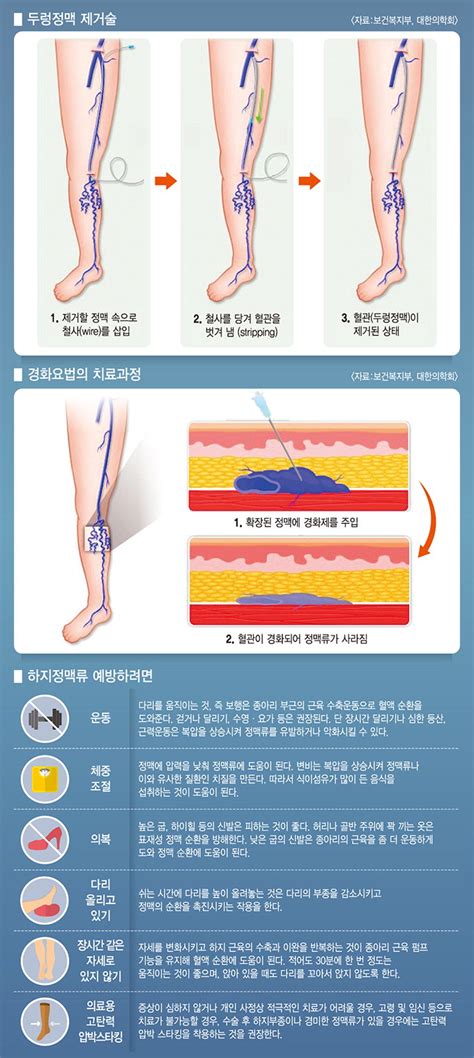 하지정맥류 방치하면 정맥성 고혈압·만성정맥부전 진행 영남일보 사람과 지역의 가치를 생각합니다