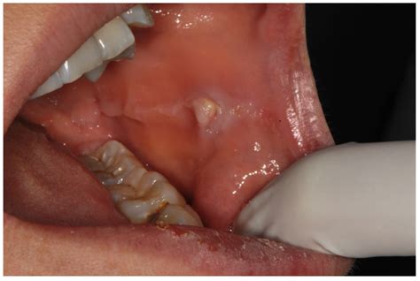 Symmetry Free Full Text Prevalence And Characteristic Of Oral