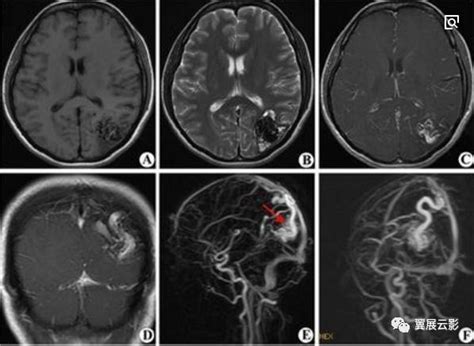 颅内各部位病变的影像鉴别诊断 脑医汇 神外资讯 神介资讯
