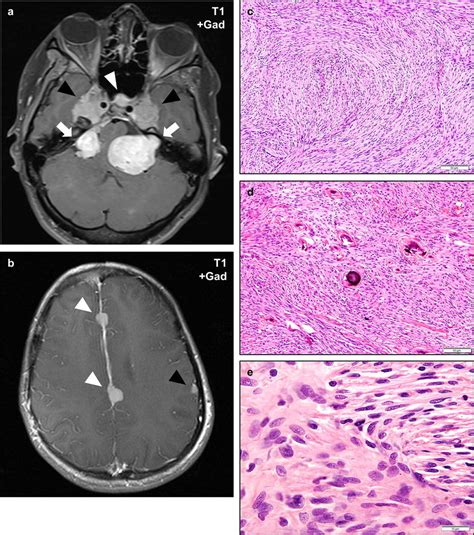 Meningiomas In NF2 NF2 Patients Frequently Develop Multiple