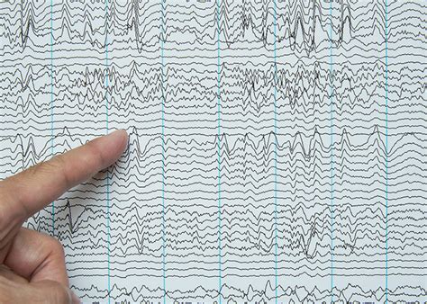 Emg Ncv Ncs Electromyograms Hunterdon Neurology