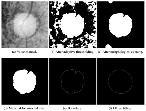 Multiple Preprocessing Hybrid Level Set Model For Optic Disc