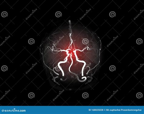 Angiografía Por Resonancia Magnética O Cerebro Mra Imagen Mra De