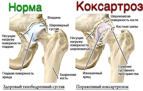 Диагностика коксартроза: методы и распространенные ошибки