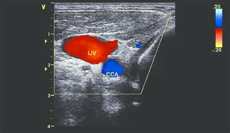 Color Flow Doppler Cfd Of Internal Jugular Vein Ijv And Common