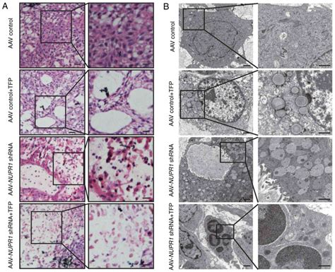 Combination Of AAVmediated NUPR1 Knockdown And Trifluoperazine Induces