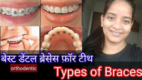 Types Of Braces Pros And Cons Of Metal Braces Ceramic Braces Invisible