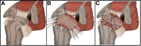 Mini Open Fascia Lata Interposition Graft Results In Superior Year