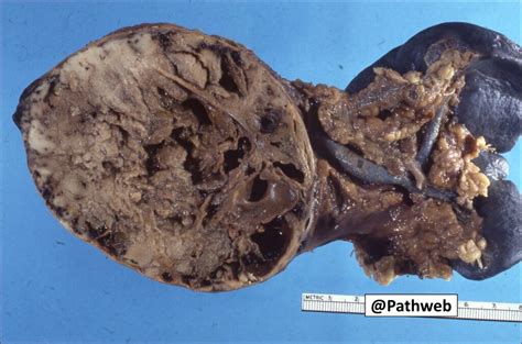 Pancreas With Spleen Solid Pseudopapillary Neoplasm Of The Pancreas