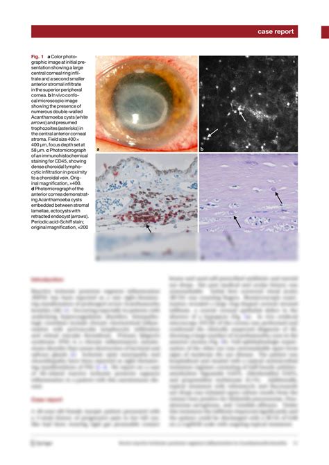 Solution Severe Reactive Ischemic Posterior Segment Inflammation In Acanthamoeba Keratitis