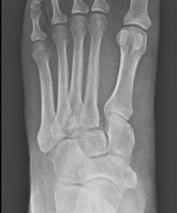 Lisfranc Fracture Dislocation Premier Radiology Services