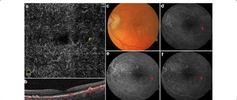 Vascularized Druse On Multimodal Imaging A Typical Yellow Drusenoid