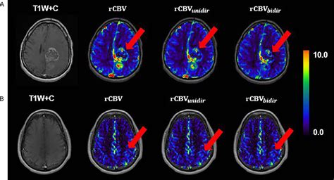 Frontiers Effect Of Applying Leakage Correction On Rcbv Measurement