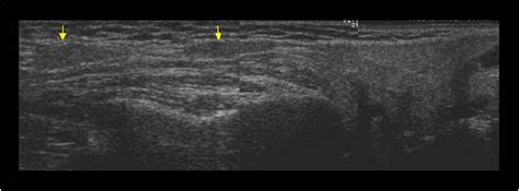 Parotid Gland On Ultrasound