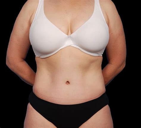 Tummy Tuck Before After Estetica Istanbul