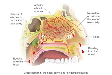 Nosebleeds Dr Aykut Unsal Philadelphia