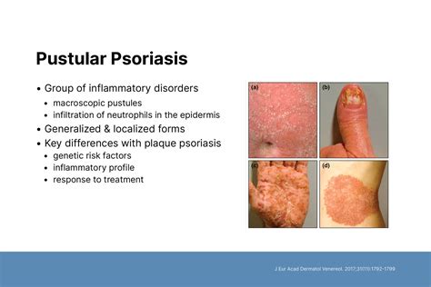 Updates in Pustular Psoriasis - Dermatology Focus