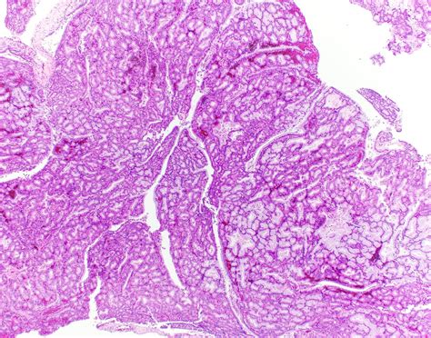 Pathology Outlines Intracholecystic Papillary Neoplasm