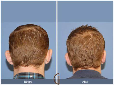 Brachycephaly In Adults