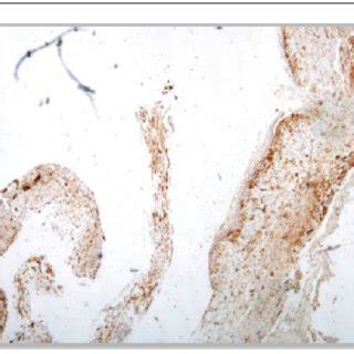 Photomicrograph Showing Sma Immunoexpression Solid Multicystic