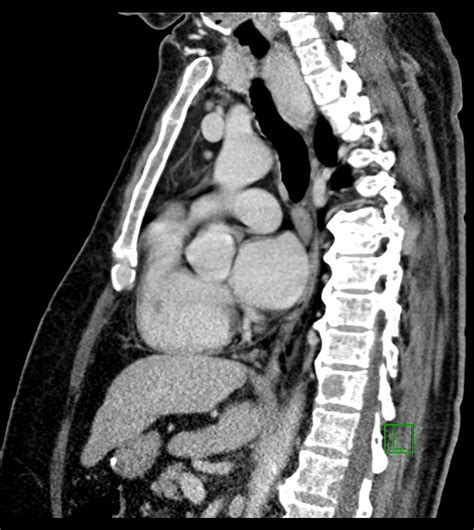 Multiple Myeloma Image