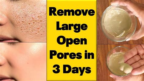 How To Get Rid Of Large Open Pores Permanently In Just 3 Days Diy Open Pores Treatment At Home