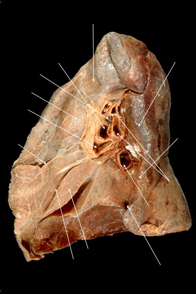 Hilum Of Right Lung Diagram Quizlet