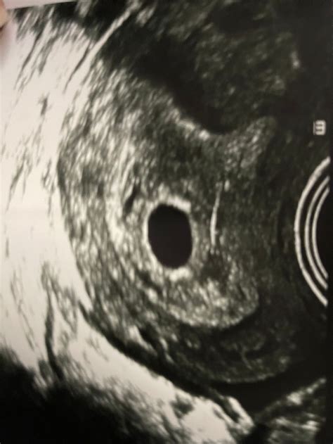 5w4d Ultrasound Gestational Sac But No Yolk Sac But My HCG Levels Are