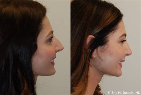 Eric M Joseph Md Rhinoplasty Before And After Deviated Septum