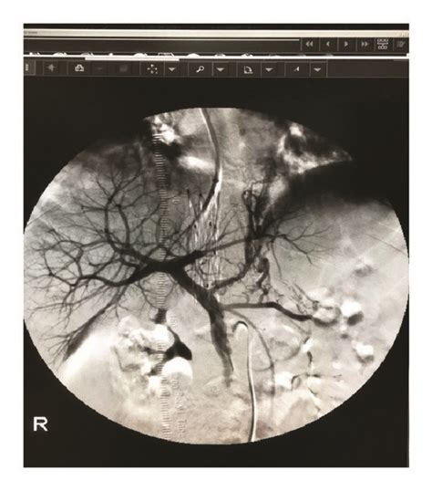 Dips Placement Combined With Ivc Stenting In Sos A Female Patient