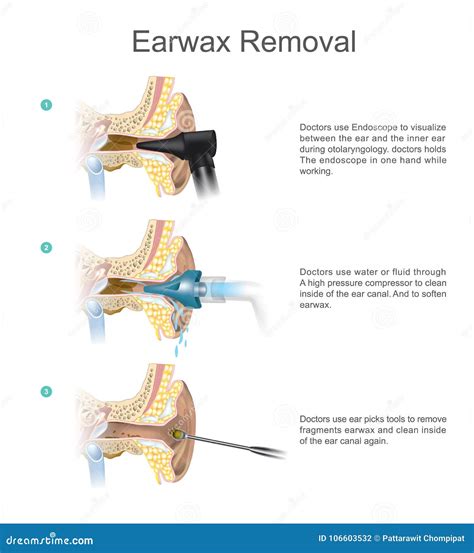 Earwax Removal. EARWAX S A Common Problem Which Is Easily Treated ...