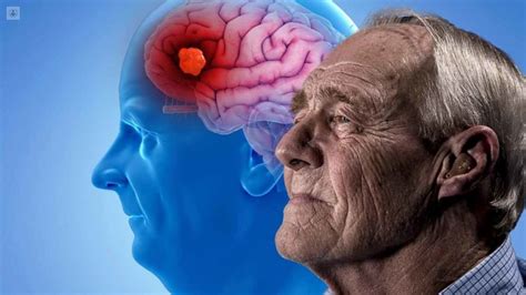 Lecanemab El Nuevo Y Esperanzador Fármaco Contra El Alzheimer Genera División Entre Los