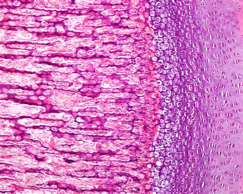 What Is Achondroplasia