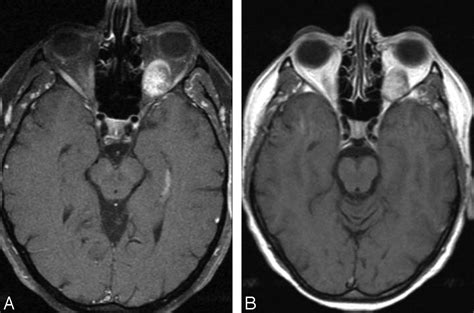 Orbital Cavernous Hemangiomas American Journal Of Neuroradiology