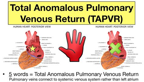 Congenital Heart Diseases Cyanotic Defects Made Easy EZmed