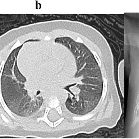 Severe Bronchomalacia Fish Mouth Appearance On Flexible Bronchoscopy