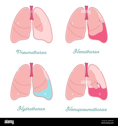 Pleural Effusion Vs Pneumothorax