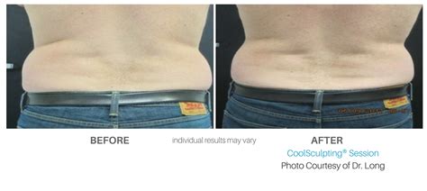 Coolsculpting Cincinnati Freeze Your Fat