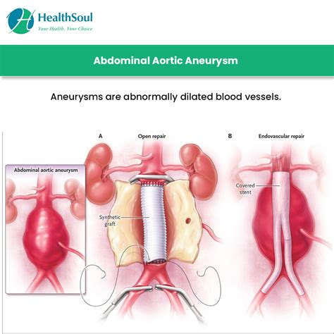 Abdominal Aortic Aneurysm Surgery: Indications and Risks – Healthsoul