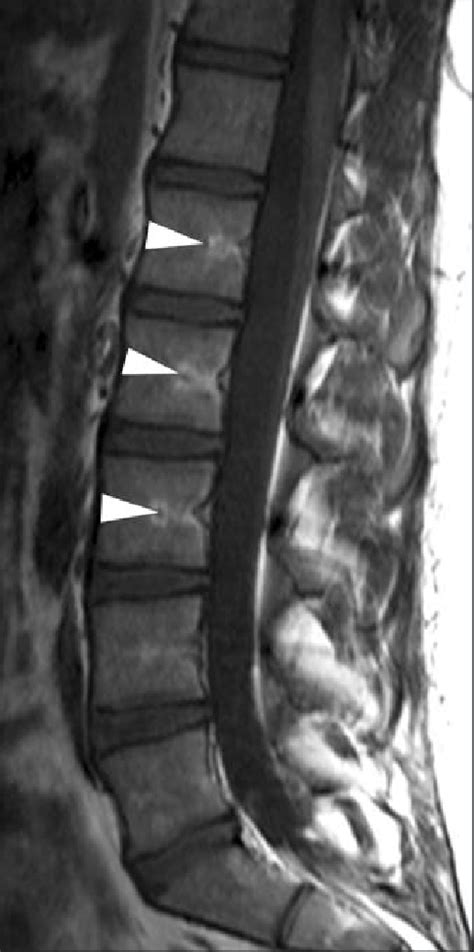 Year Old Man With Vague Back Pain Sagittal T1 Weighted Spin Echo Image