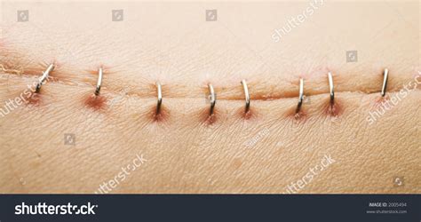 Metal Staples Satures Scar Left Laparotomylaparoscopy Stock Photo ...