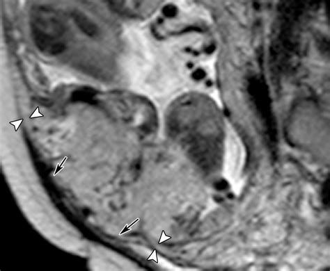 Placental Imaging Normal Appearance With Review Of Pathologic Findings