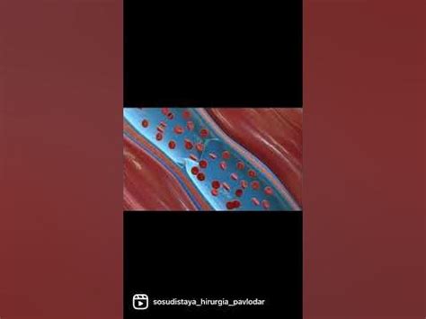 Варикозные вены/расширение подкожных вен/ варикоз механизм/көк тамырдың ...