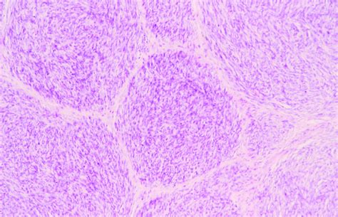 Benign Solitary Schwannomas Bone Joint