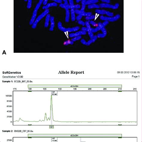 Molecular Cytogenetic Analysis For 70 Patients Multiplex