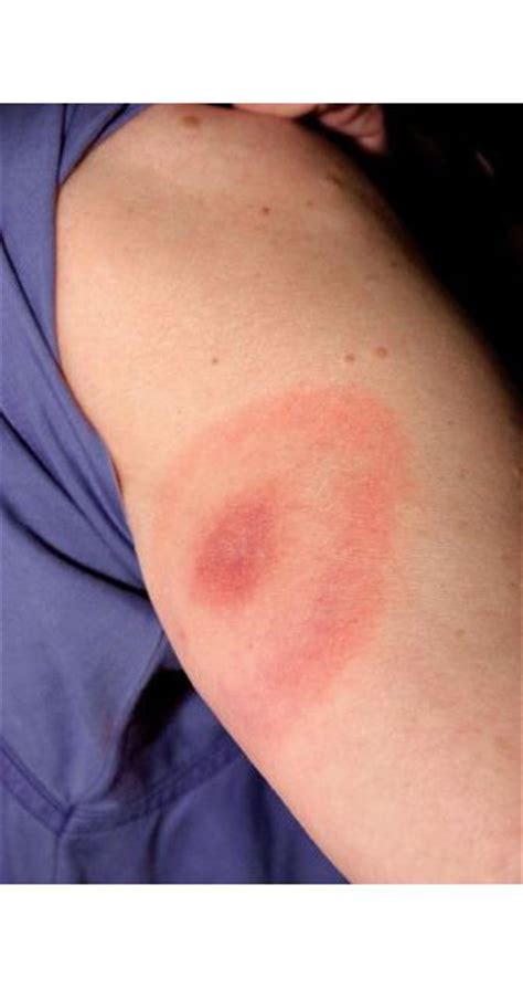 Gallery Of Lyme Disease Pictures