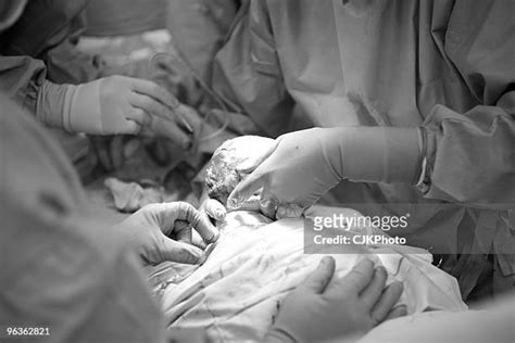 Caesarean Section Photos And Premium High Res Pictures Getty Images