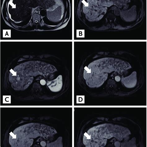 Magnetic Resonance Imaging Mri Findings Of The Liver Reveal Multiple Download Scientific