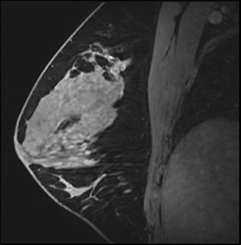 Normal Breast MRI Dense Breasts Image Radiopaedia Org