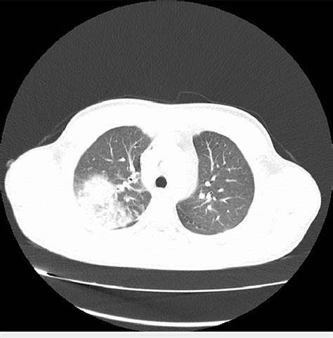 Ct Lung Ct Lung Showing Right Sided Pneumonia And Right Sided Pleural